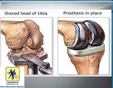 Slider image (4) Dr. Narendra Vaidya | Joint Replacement Specialist